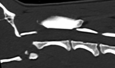 Scanner montrant l'instabilité atlanto-occipitale avant chirurgie