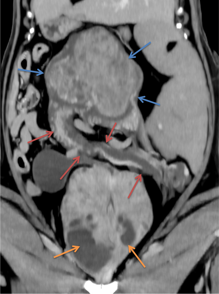 Scanner : Tumeur testiculaire sur ectopie chez un chien (flèches bleues). Les flèches rouges montrent le cordon spermatique épaissi. Les flèches oranges montrent des abcès prostatiques. VetRef, Angers