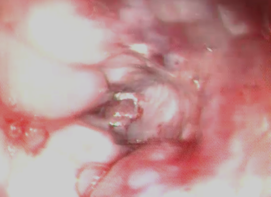 Fibroscopie œsophagienne. L'image est réalisée juste en amont du cardia. 