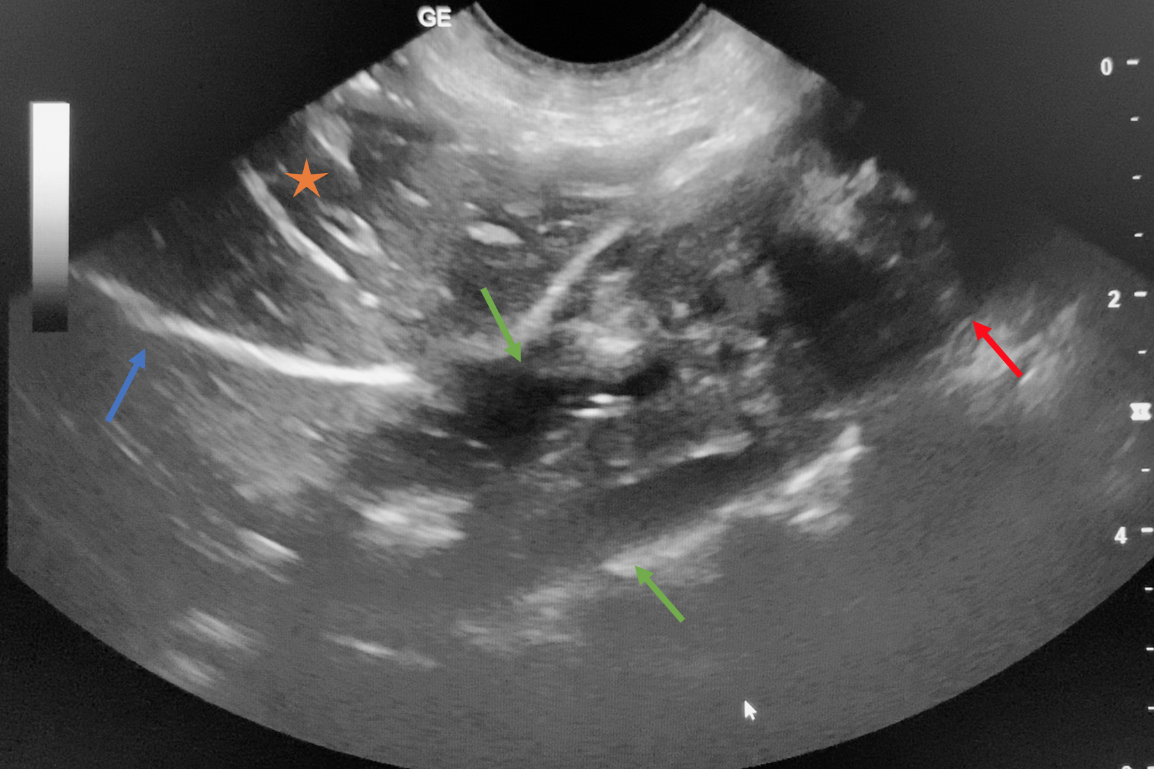 Echographie de l'oesophage et du cardia (flèche bleue : diaphragme, étoile : foie, flèches vertes : œsophage, flèche rouge : région du cardia).